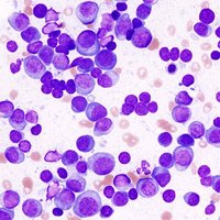 Myeloma cells