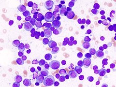 myeloma cells under a microscope