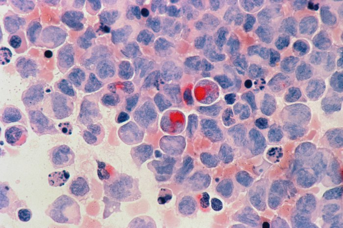 Acute myelocytic leukaemia (AML)